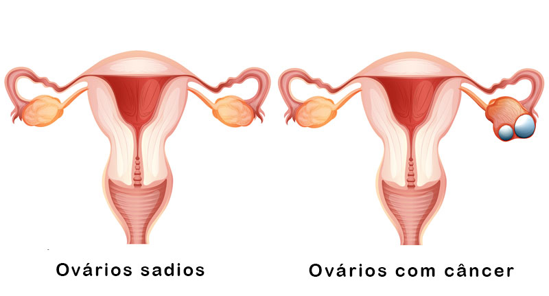 Como é a vida após a retirada dos ovários? - Oncologista em São Paulo