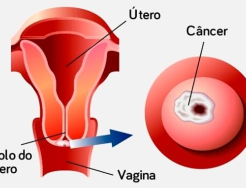 Câncer no Colo do Útero